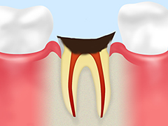 【C4：歯根に達した末期の虫歯】