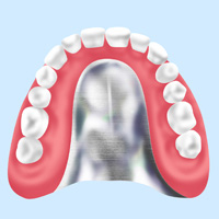 金属床義歯（自費診療）